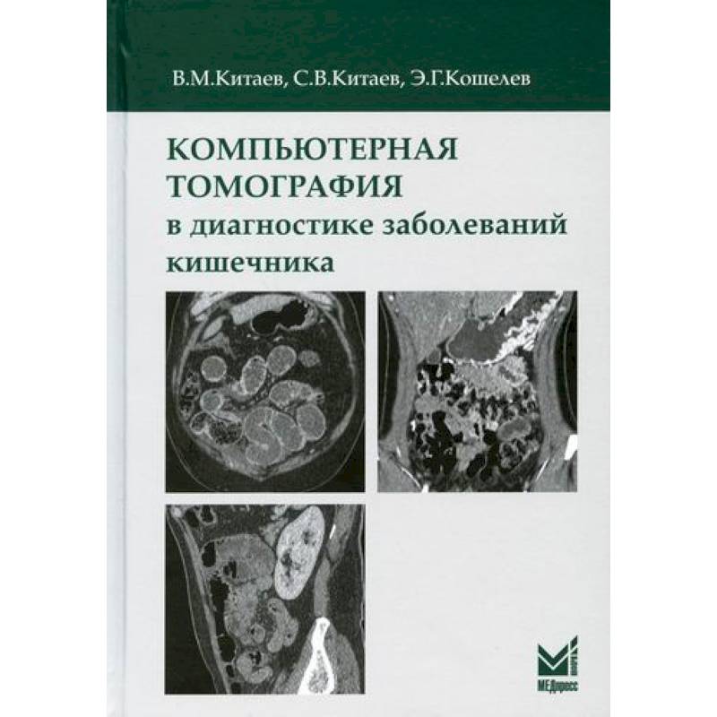 Компьютерная томография в диагностике заболеваний кишечника